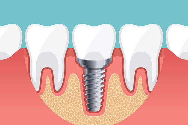 Treatments To Improve Dental Implant Candidacy